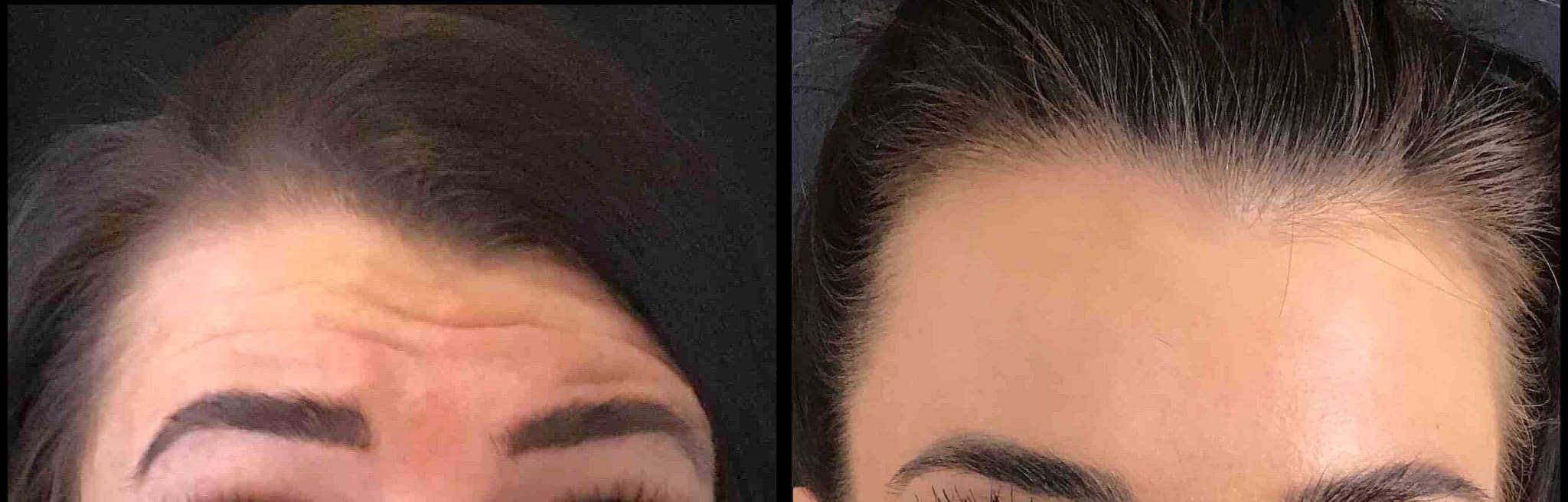 Botox Cincinnati Before After Photo Botox Cincinnati Before After Photo