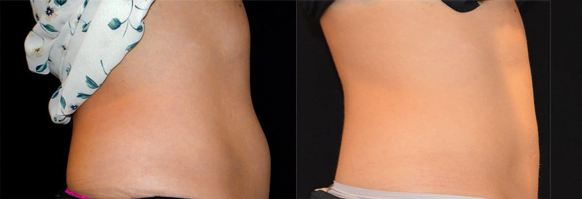Cincinnati Coolsculpting Treatment Before and After Photo