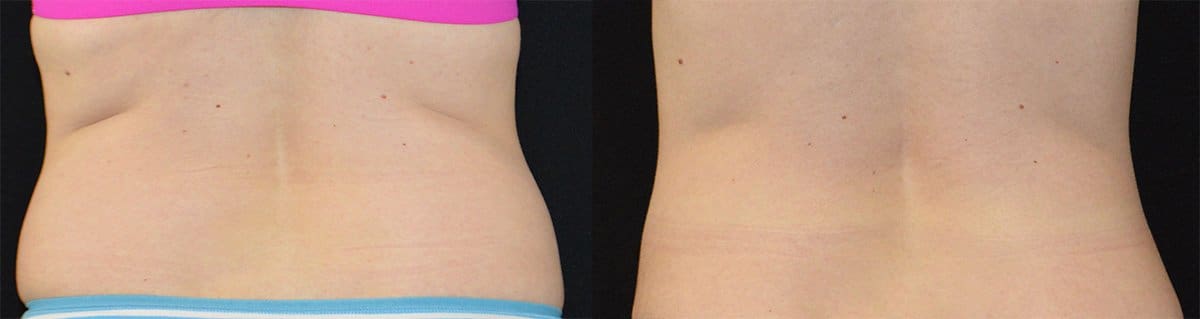 Cincinnati Coolsculpting Treatment Before and After Photo