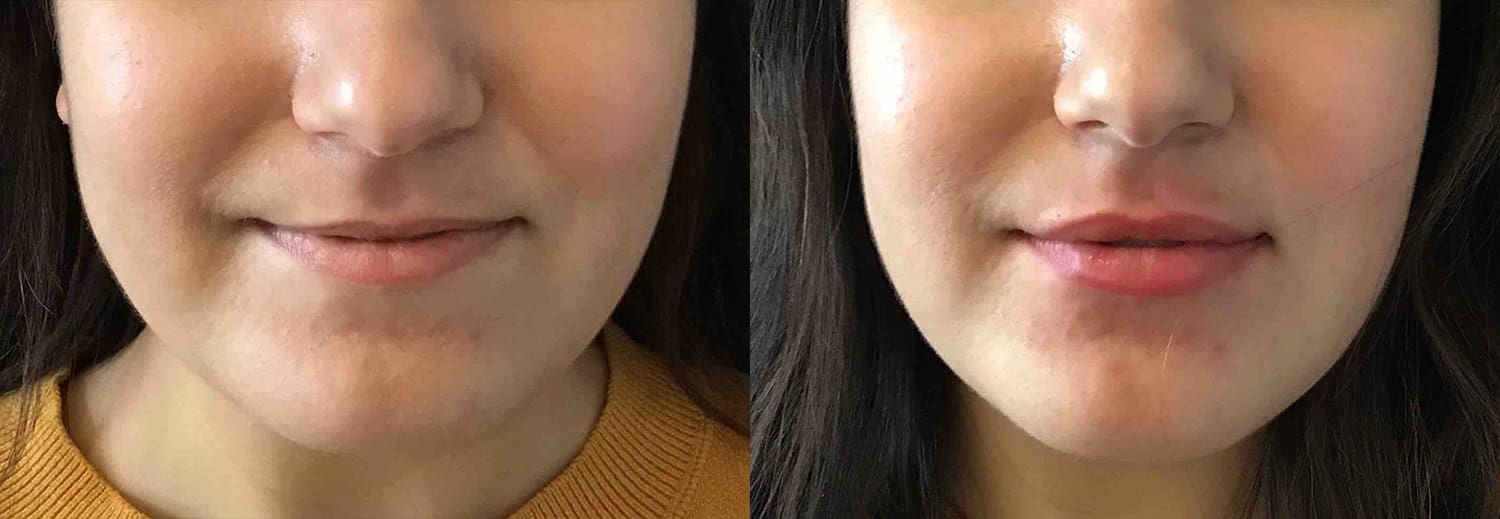 Filler_1 Cincinnati Filler Treatments