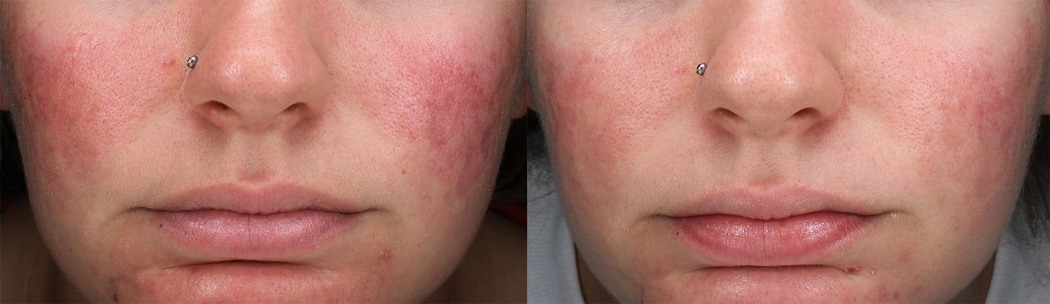 IPL_1 Cincinnati IPL Intense Pulse Light Patient Before and After