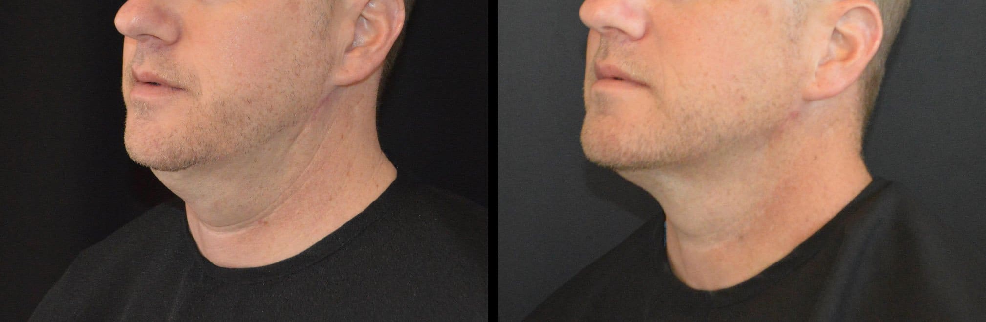 Cincinnati Kybella Treatment Before and After Photo