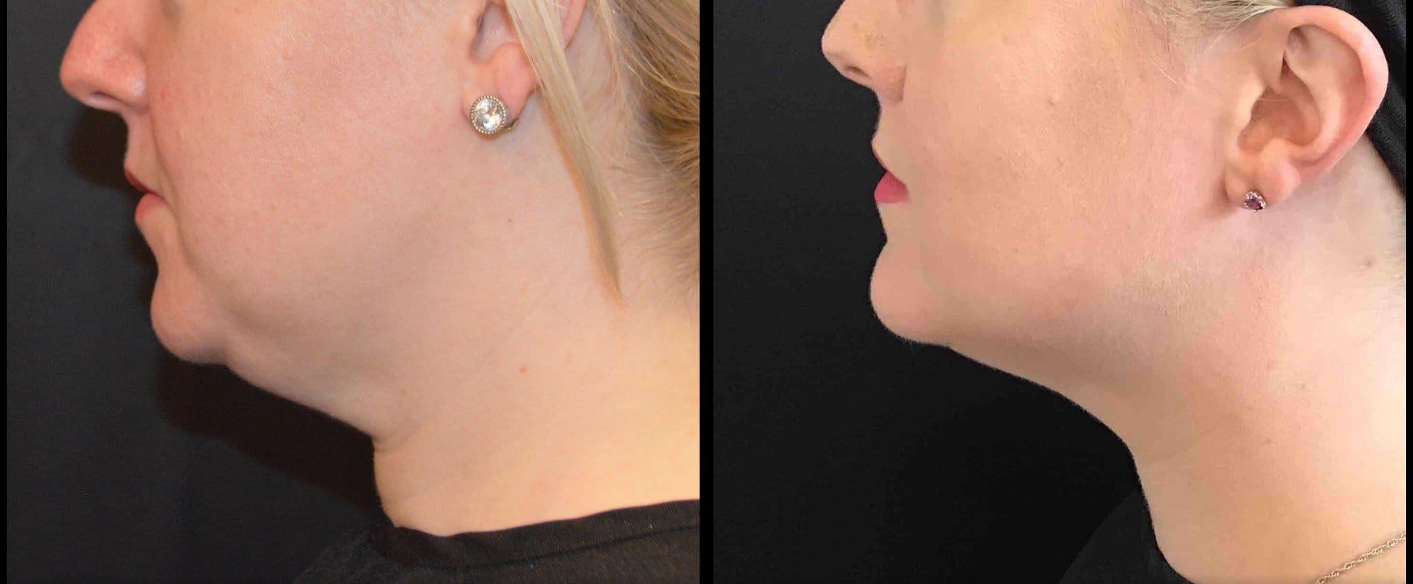 Cincinnati Kybella Treatment Before and After Photo