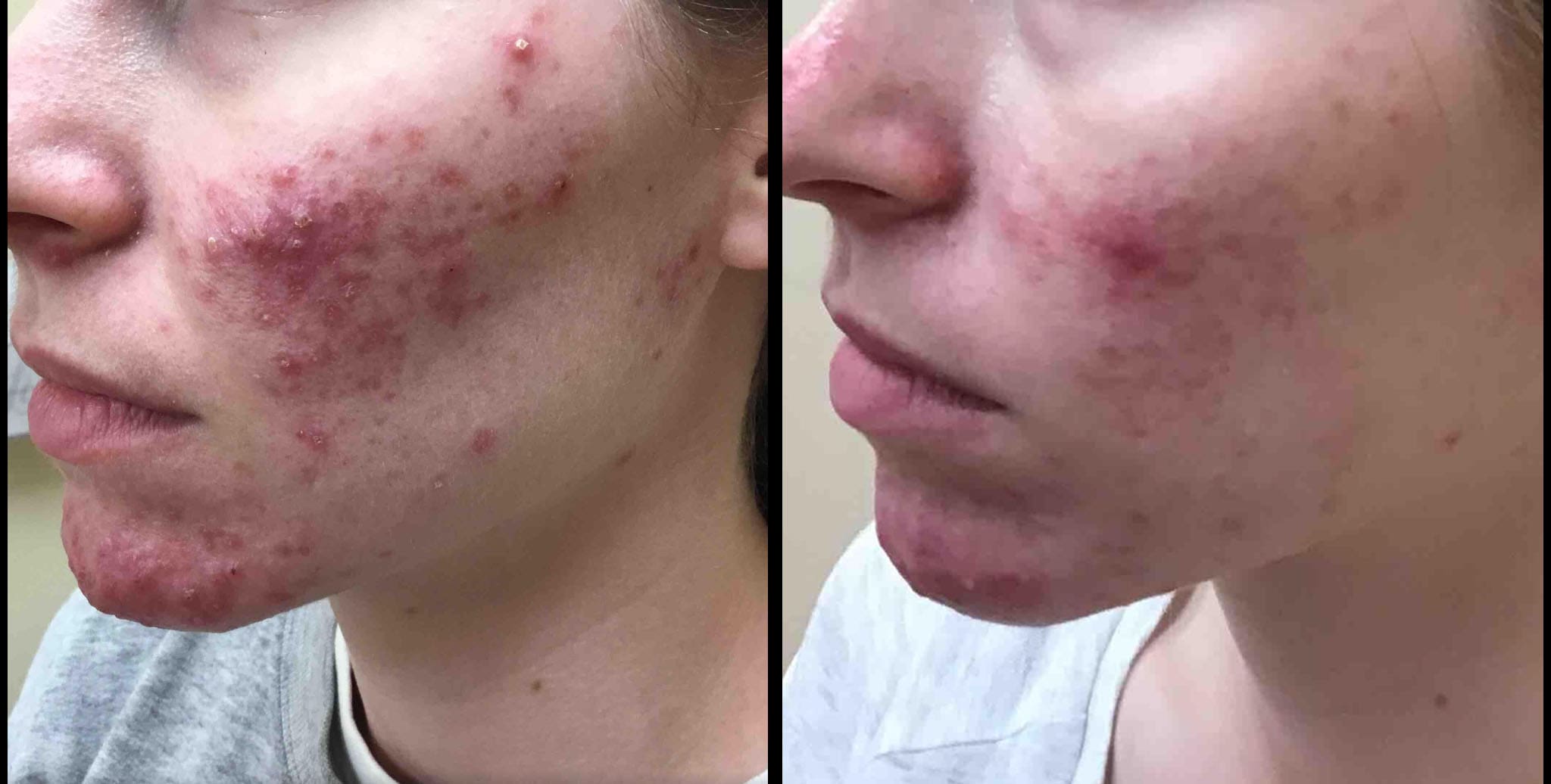 Cincinnati Acne Treatment LED Light Therapy Before and After