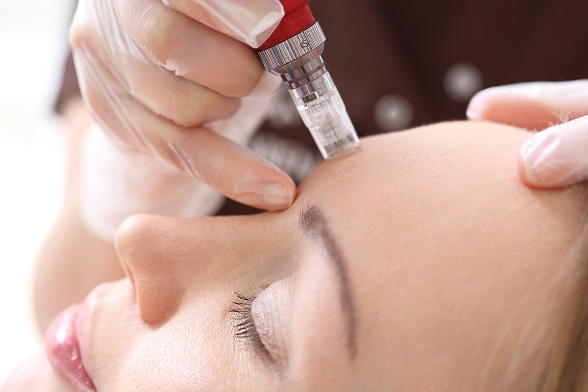 Microneedling Cincinnati Microneedling Treatments