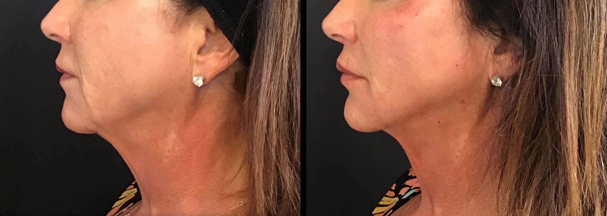 Cincinnati Nova Threads Thread Lift Patient Before and After