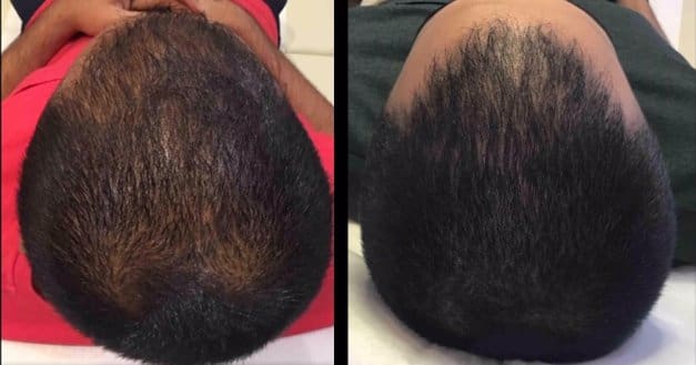PRP_1 Cincinnati Platelet-Rich Plasma (PRP) for Hair Loss Scalp Patient Before and After