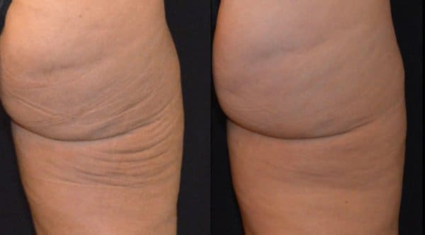 Ultherapy Mona Dermatology