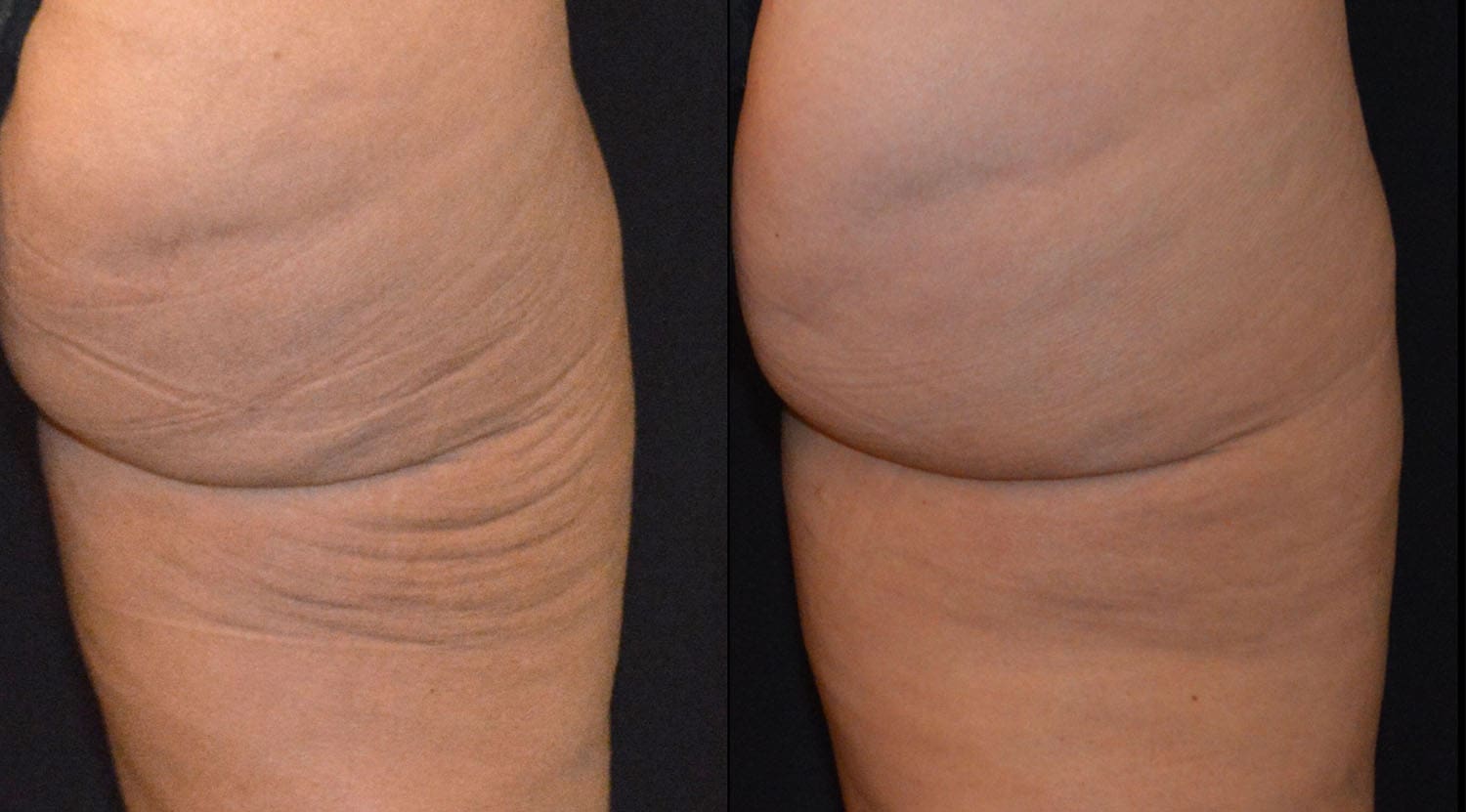 Ulthera_1 Cincinnati Ultherapy Treatments