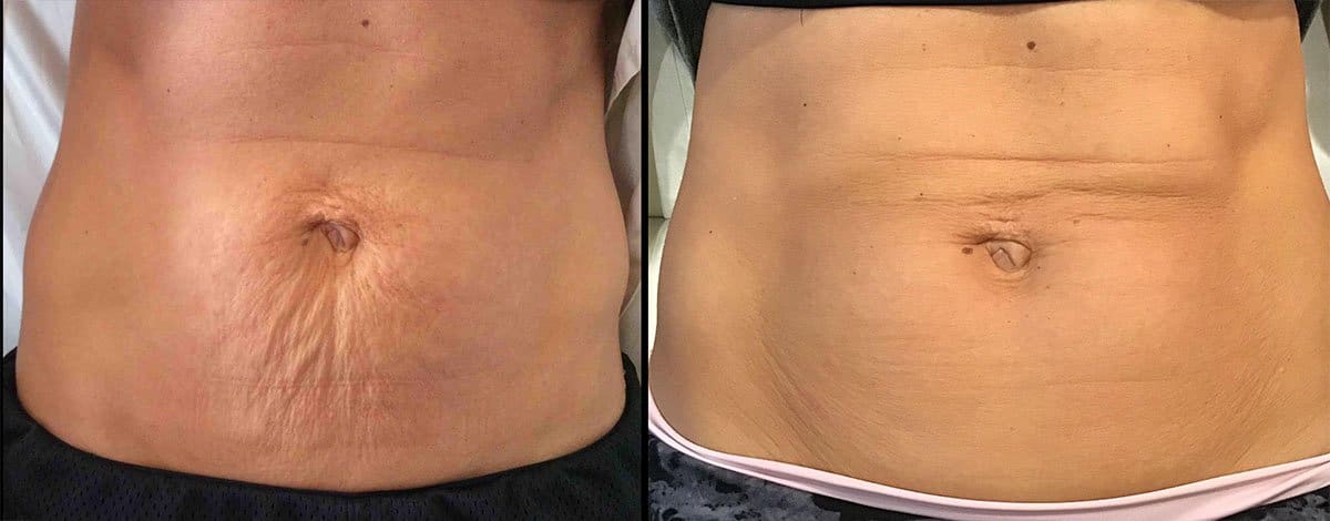 Ulthera_2 Cincinnati Ultherapy Treatments