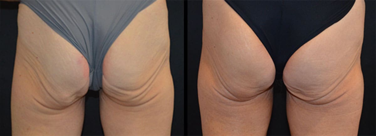 Ulthera_3-1 Cincinnati Ultherapy Treatments
