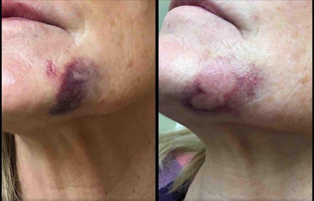 Cincinnati VBeam Treatments Patient Before and After Photos