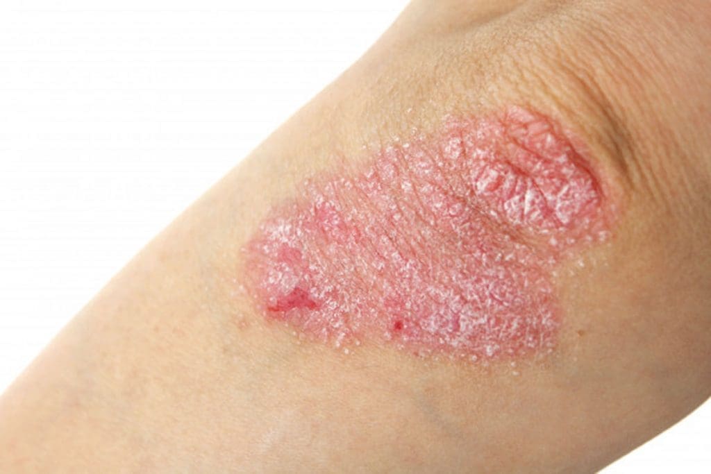 Chronic Psoriasis Chronic Psoriasis