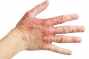 Eczema and Atopic Dermatitis