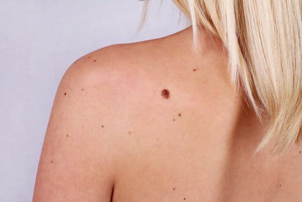 Cincinnati Mole Treatments