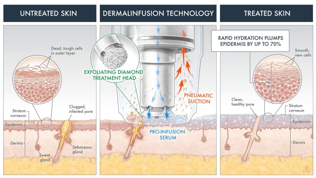 Cincinnati Dermalinfusion Treatments