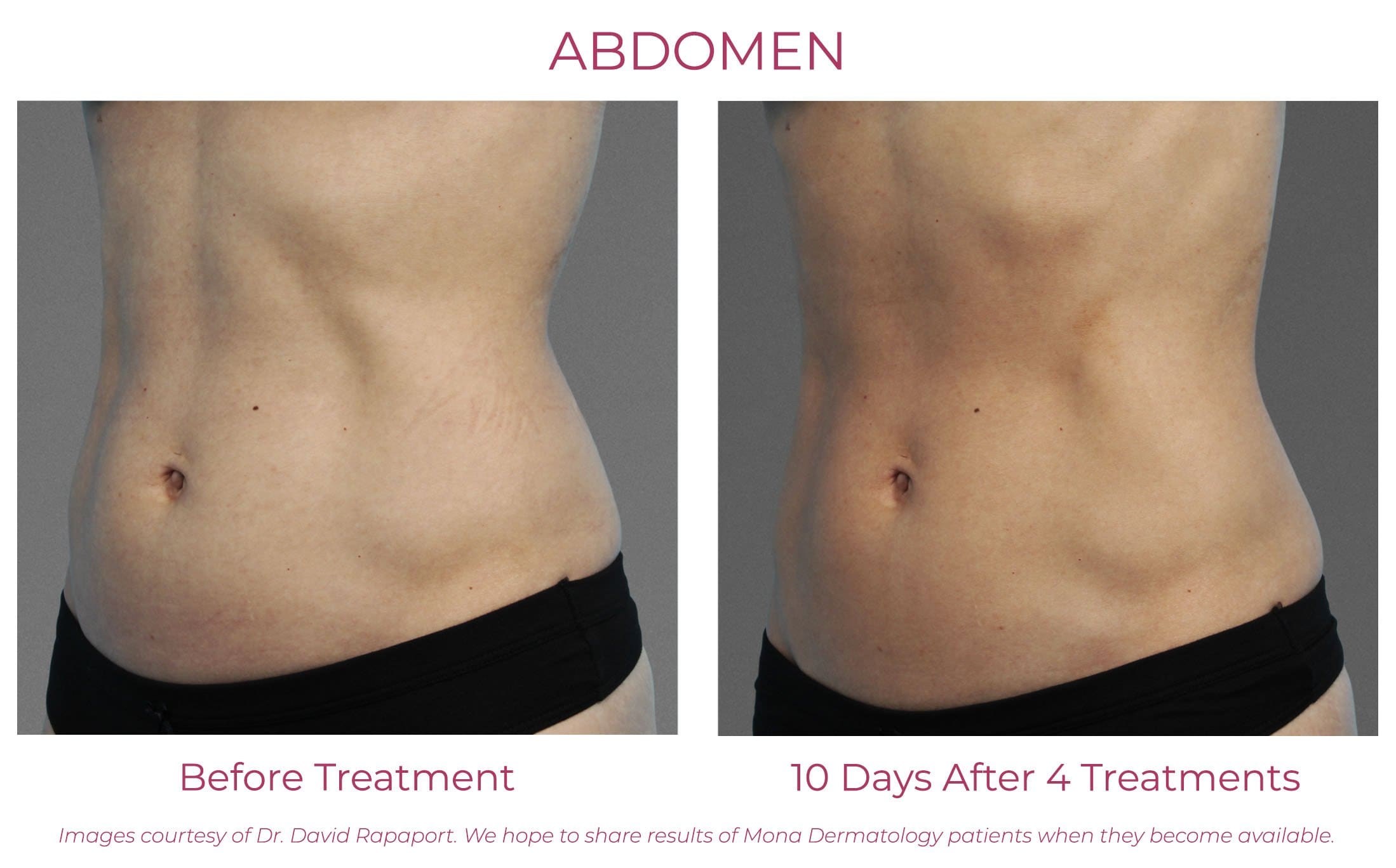 Cincinnati CoolTone Body Toning Treatments, Patient Before and After Photo Abdomen