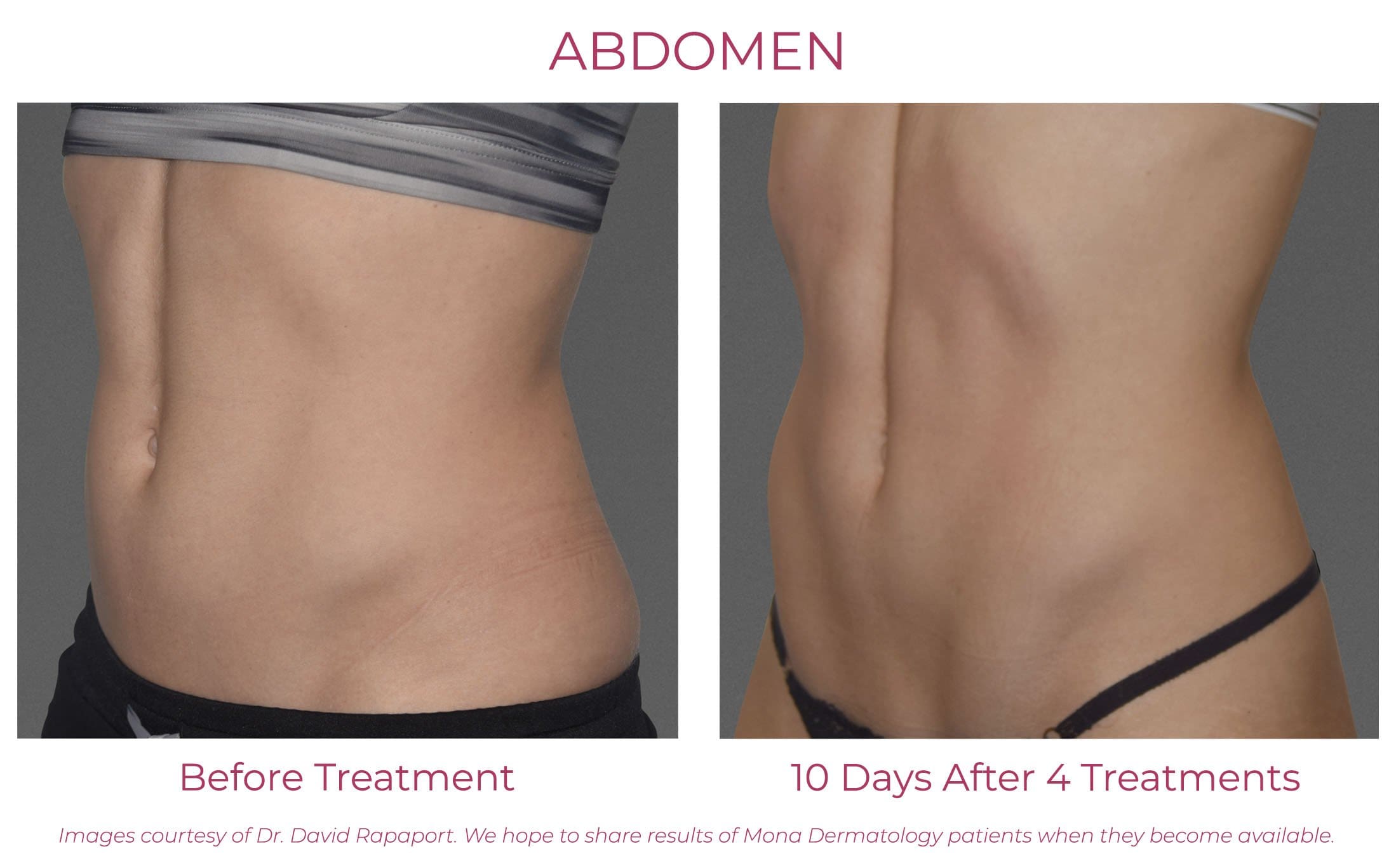 Cincinnati CoolTone Body Toning Treatments, Patient Before and After Photo Abdomen