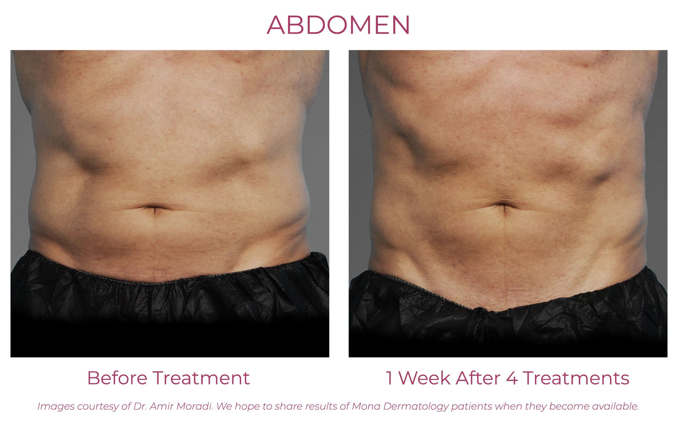 Cincinnati CoolTone Body Toning Treatments, Patient Before and After Photo Abdomen