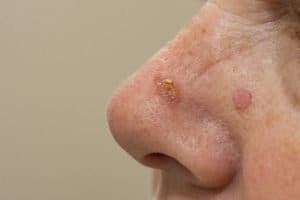 ACTINIC KERATOSES Pre-Cancers