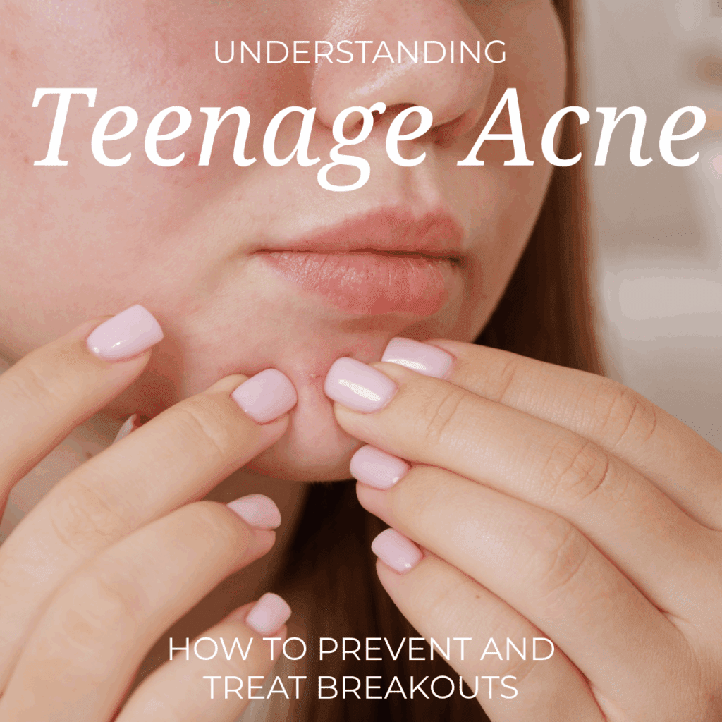 Understanding Teenage Acne: How to Prevent and Treat Breakouts