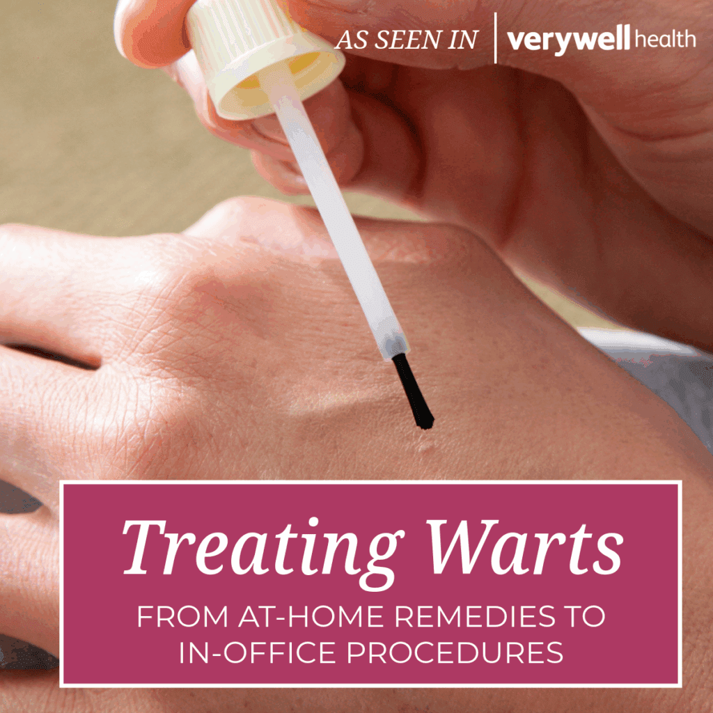 Treating Warts: From At-Home Remedies to In-Office Procedures
