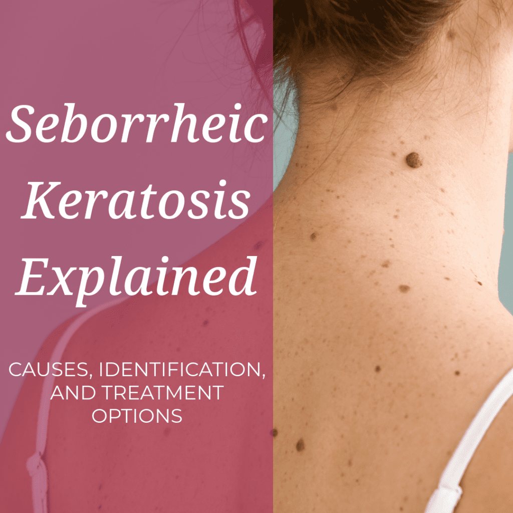 Seborrheic Keratosis Explained: Causes, Identification, and Treatment Options