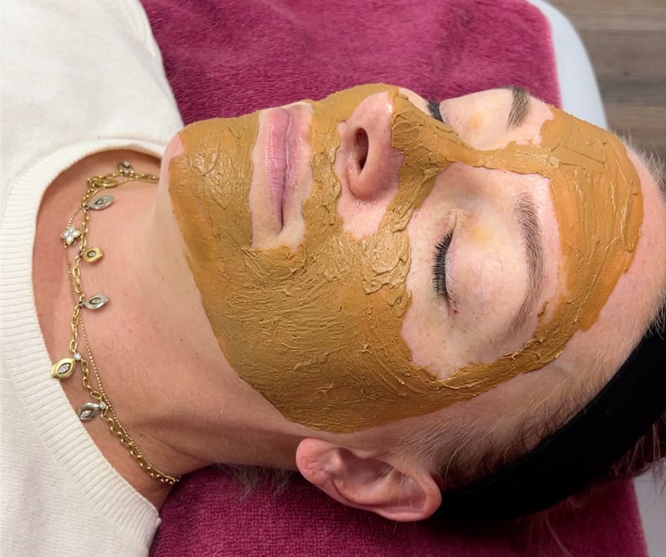 Cincinnati Cosmelan Peel Melasma Treatment