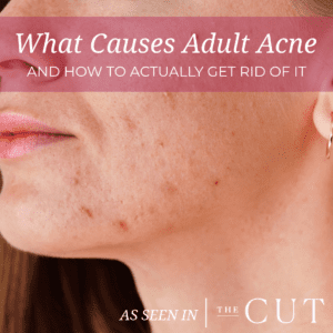 Adult Acne