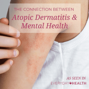 Atopic Dermatitis