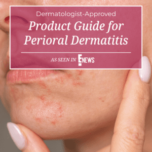 periorial dermatitis