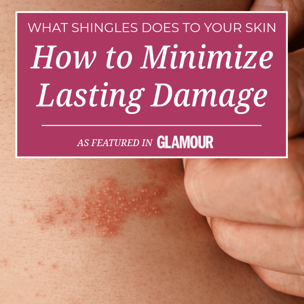 shingles