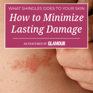 shingles