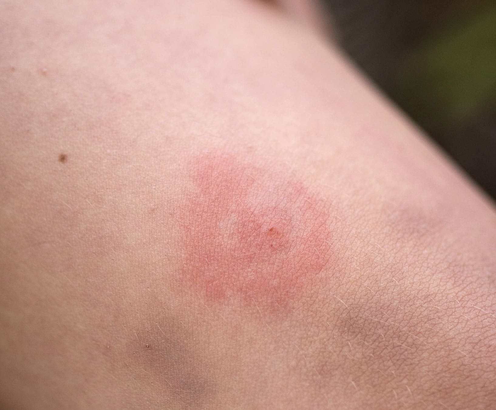 Ring formation indicating Lyme disease from tick bite